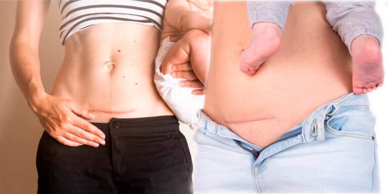 cesarea-cuidados-dolor